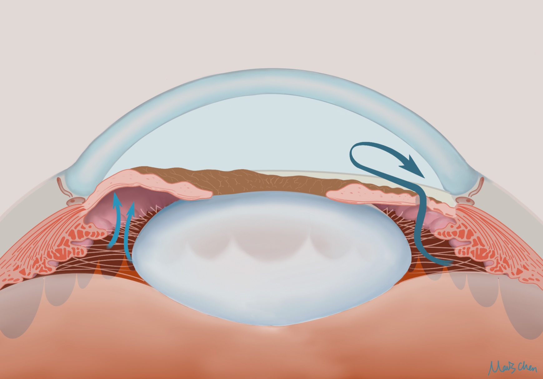 Laser iridotomy
